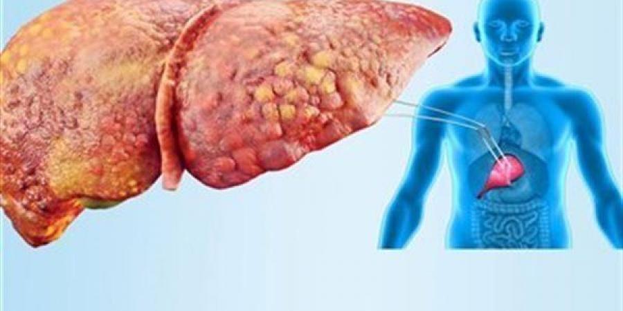 علامات الكبد الدهني التي قد تظهر على الجسم