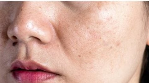 كيف يتغير شكل الوجه نتيجة ارتفاع الكوليسترول.. لا تتجاهل هذه العلامات