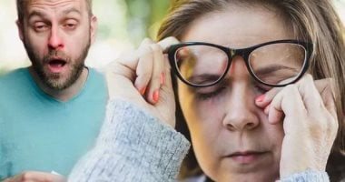 لمرضى الحساسية..ما هى قاعدة الساعتين وعلامات تحذيرية هامة؟